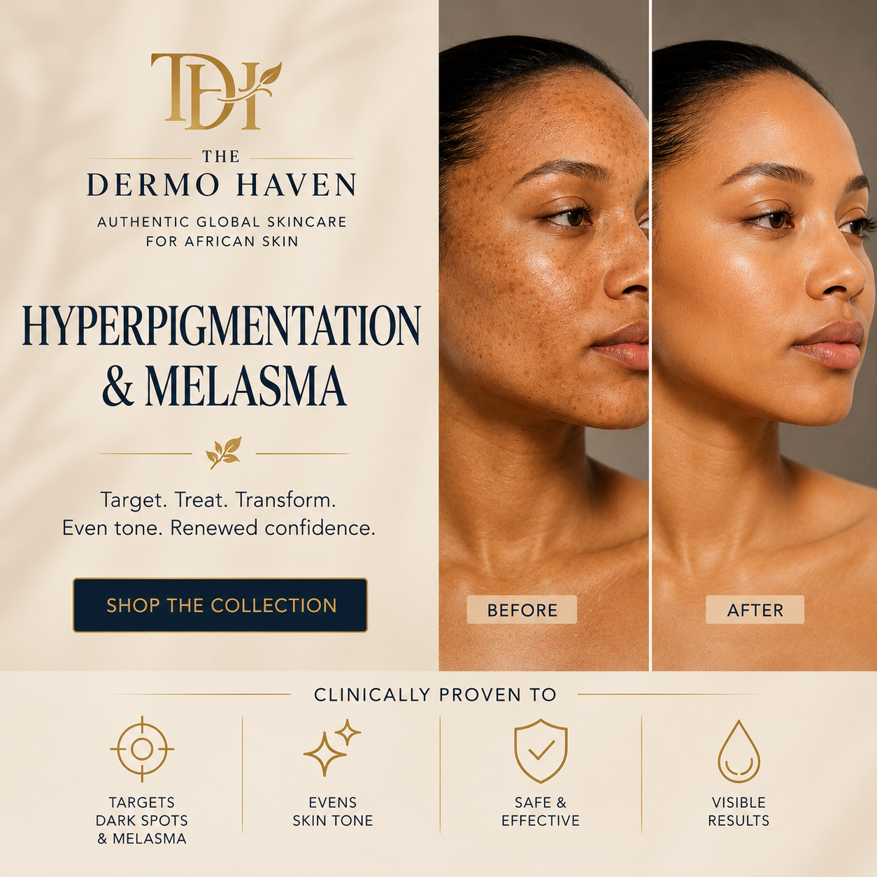 Hyperpigmentation & Melasma